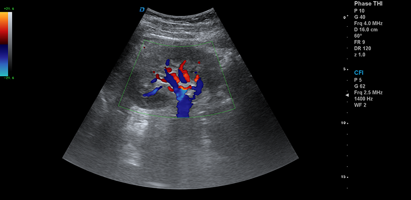 彩超機(jī)腎臟血流檢測(cè)圖