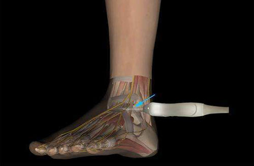 肌骨超聲：肌肉損傷超聲怎么看？